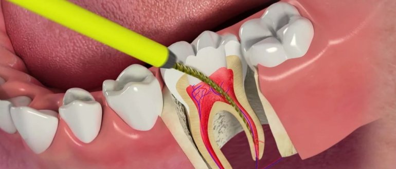 Лечение пульпита. От чего может возникнуть сильная боль?