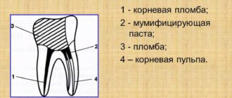 Комбинированный метод лечения пульпита