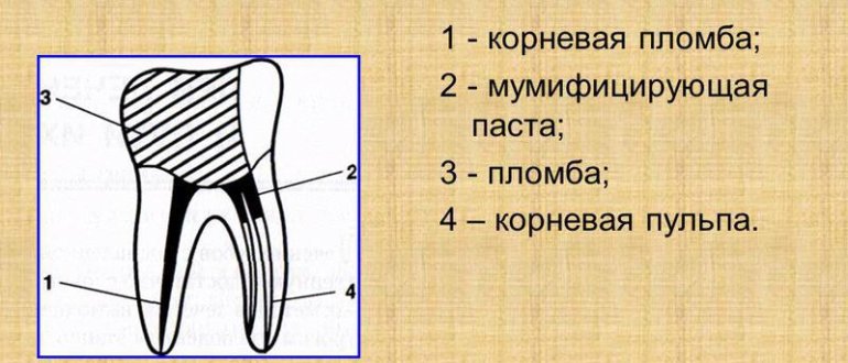 Комбинированный метод лечения пульпита