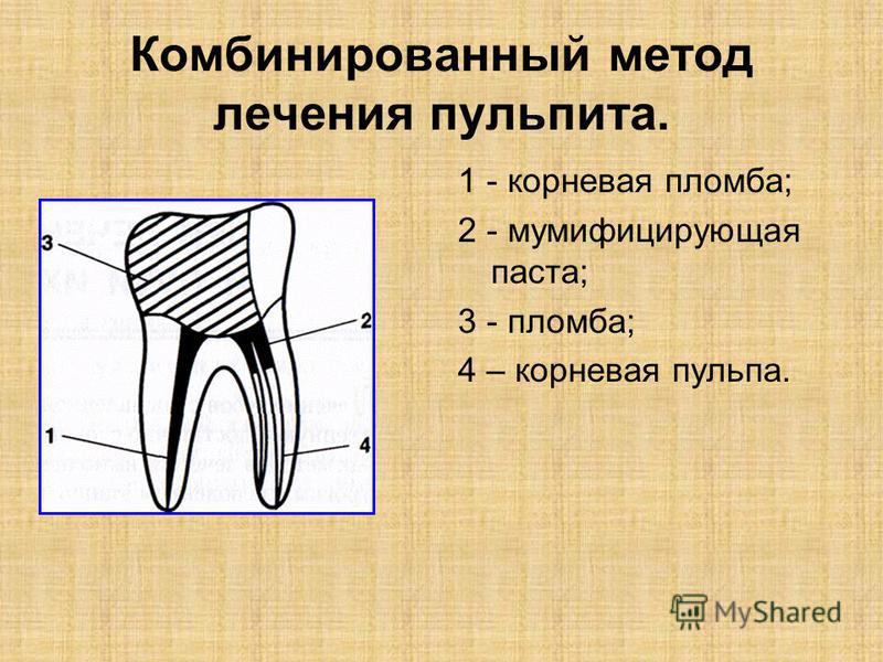 Комбинированный метод лечения пульпита