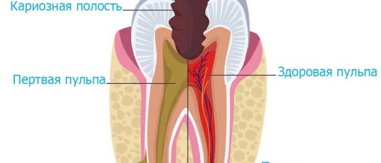 Участки дентина при пульпитах