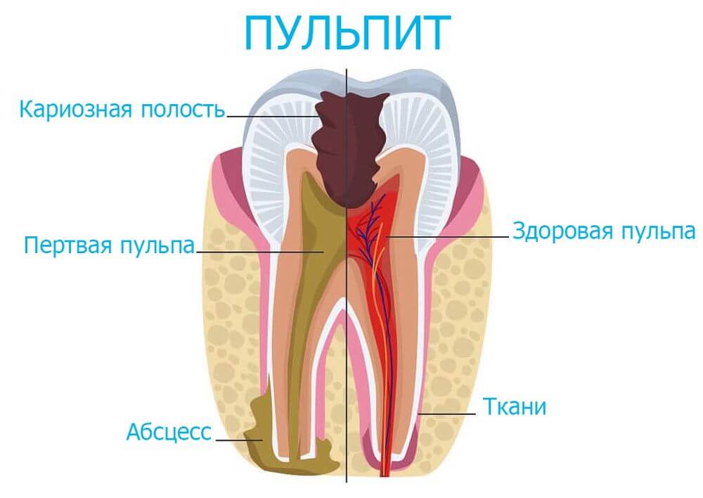 Участки дентина при пульпитах