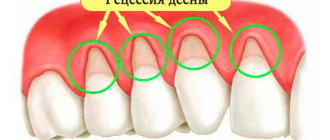 Новый метод борьбы с рецессией десен