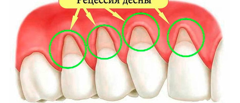 Новый метод борьбы с рецессией десен