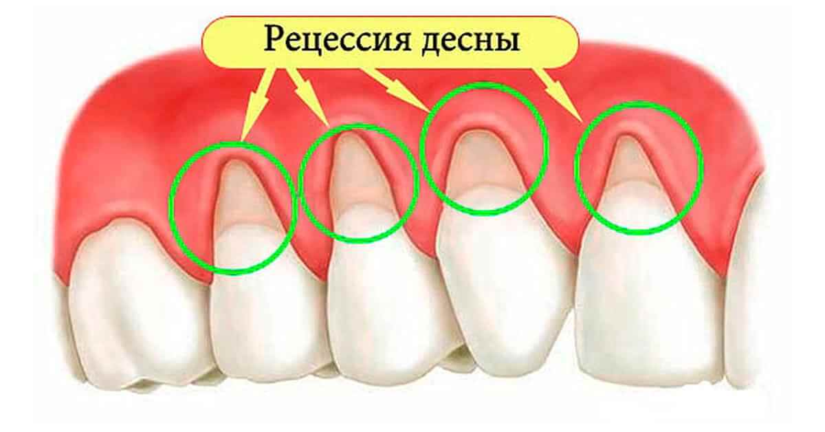 Новый метод борьбы с рецессией десен