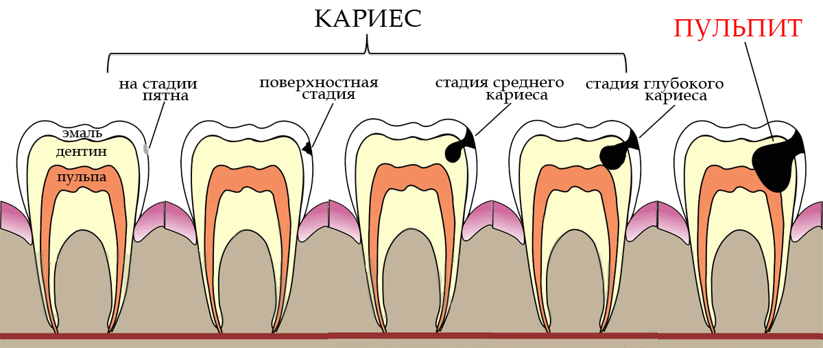 Современные методы  лечения кариеса