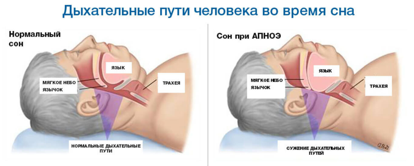 Современные методы лечения апноэ сна