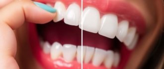 Can You Whiten Dental Crowns? Exploring Your Options for a Brighter Smile