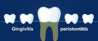 Gingivitis vs. Periodontitis: Understanding the Silent Battle in Your Mouth