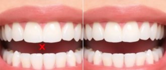 Lumineers vs. Traditional Veneers: Which Smile Makeover is Right for You?