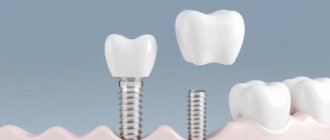 Dental Implants: Your Guide to Permanent Tooth Replacement