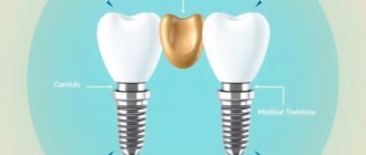 All-on-4 Implant Procedure Explained: A Complete Guide to Your New Smile