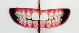 Broken Braces Wire Solutions: What to Do When Your Brace Wire Breaks