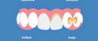Dental Inlays and Onlays Explained: What You Need to Know for a Healthy Smile