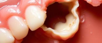 Lost Filling or Crown: Temporary Fixes to Keep You Comfortable Until the Dentist