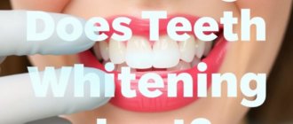 How Long Does Teeth Whitening Last? Understanding the Longevity of Your Bright Smile