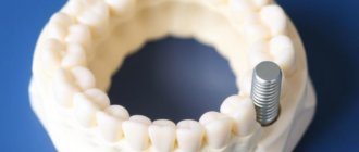 Missing a Tooth? Zahnersatz: Br?cke, Teilprothese oder Implantat — Which One Fits You?