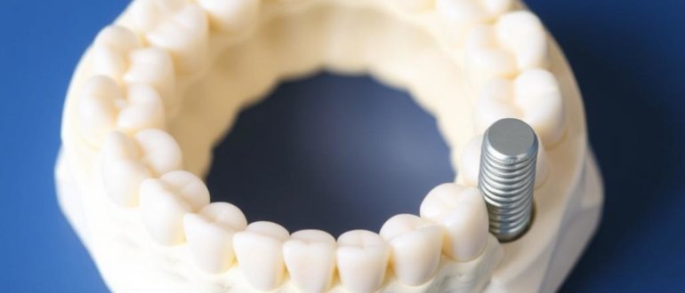 Missing a Tooth? Zahnersatz: Br?cke, Teilprothese oder Implantat — Which One Fits You?