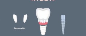 Prothesen ? la fran?aise: Les diff?rents types de proth?ses dentaires (amovibles, fixes, sur implants) — Ein unterhaltsamer Leitfaden f?r jeden, der sein L?cheln zur?ckhaben m?chte