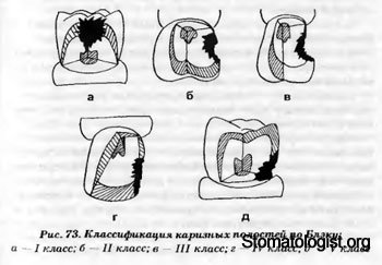 Принципы и техника препарирования твердых тканей зуба при кариесе