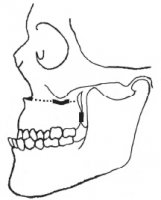 Способы фиксации нижней челюсти в медиа дистальном положении