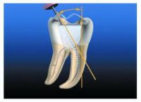 Апикально-коронковая методика обработки корневого канала