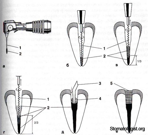 Пломбирование корневого канала пластическими пломбировочными материалами