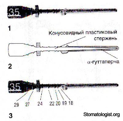 Пломбирование корневого канала термопластифицированной гуттаперчей