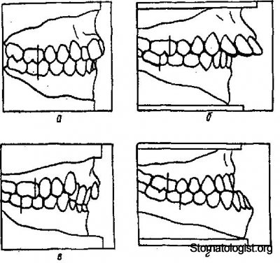 КЛАССИФИКАЦИЯ ЗУБОЧЕЛЮСТНЫХ АНОМАЛИЙ