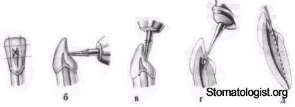 Полость зуба и ее препарирование Часть 3
