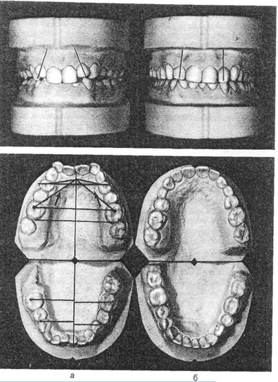 Расположение зубов и размеры зубных дуг.Сагиттальное направление