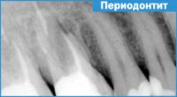 ЭТИОЛОГИЯ ПЕРИОДОНТИТА.Инфекционный периодонтит. 