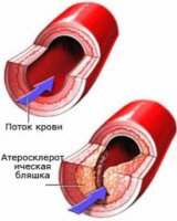 Атеросклеротическое поражение сосудов.Влияние на возникновение заболеваний пародонта