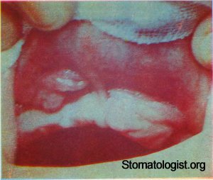ТРАВМАТИЧЕСКАЯ ЯЗВА слизистой оболочки полости рта