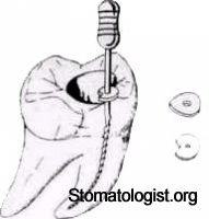 Эндодонтический инструментарий Часть 3