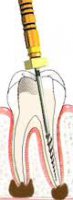 Препарирование корневого канала