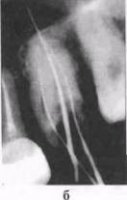 Ошибки и осложнения при эндодонтическом лечении Часть 2
