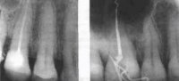 Ошибки и осложнения при эндодонтическом лечении Часть 2
