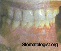 ИЗМЕНЕНИЕ СЛИЗИСТОЙ ОБОЛОЧКИ РТА ПРИ ДЕРМАТОЗАХ.Красный плоский лишай