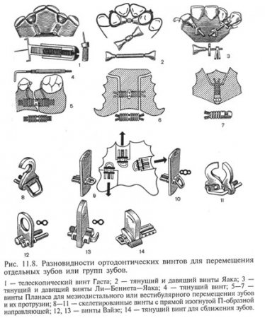 Ортодонтические винты 