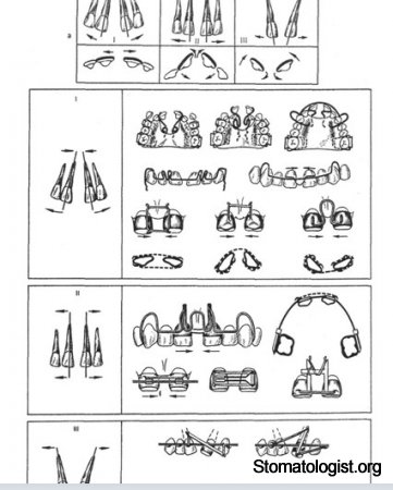 Аномалии положения зубов в трансверзальном направлении