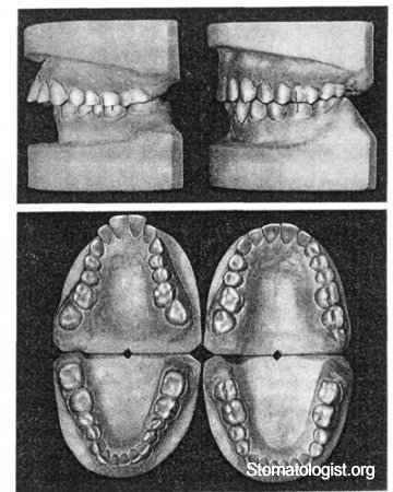 Аномалии зубных дуг в трансверзальном направлении