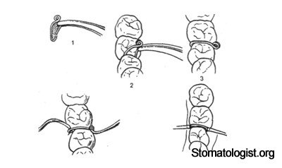 Изготовление индивидуальных колец на опорные моляры, припаивание или приваривание к ним замков-трубок или подбор стандартных колец. 