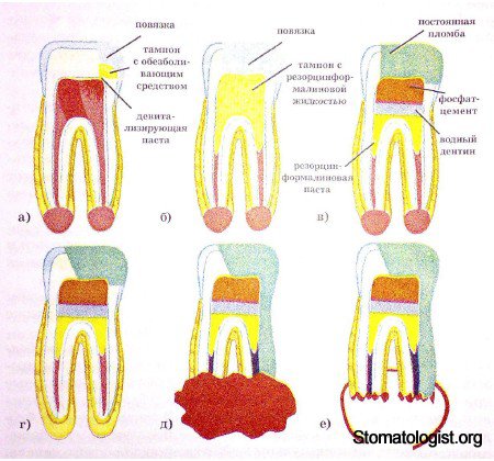ОСОБЕННОСТИ ЛЕЧЕНИЯ ПУЛЬПИТА ЗУБОВ С НЕСФОРМИРОВАННЫМИ ИЛИ РЕЗОРБИРУЮЩИМИСЯ КОРНЯМИ