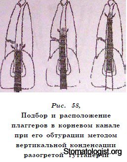 МЕТОДИКИ ОБТУРАЦИИ КОРНЕВОГО КАНАЛА ЗУБА