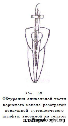 Обтурация теплой фрагментированной гуттаперчей