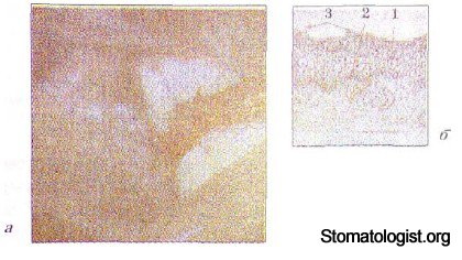 ЭЛЕМЕНТЫ ПОРАЖЕНИЯ СЛИЗИСТОЙ ОБОЛОЧКИ ПОЛОСТИ РТА. ИХ ХАРАКТЕРИСТИКА