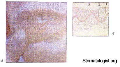ЭЛЕМЕНТЫ ПОРАЖЕНИЯ СЛИЗИСТОЙ ОБОЛОЧКИ ПОЛОСТИ РТА. ИХ ХАРАКТЕРИСТИКА