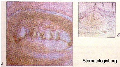ЭЛЕМЕНТЫ ПОРАЖЕНИЯ СЛИЗИСТОЙ ОБОЛОЧКИ ПОЛОСТИ РТА. ИХ ХАРАКТЕРИСТИКА