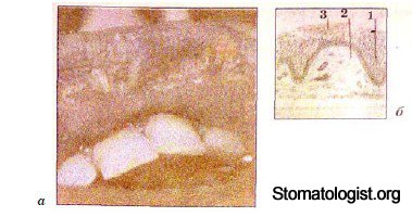 ЭЛЕМЕНТЫ ПОРАЖЕНИЯ СЛИЗИСТОЙ ОБОЛОЧКИ ПОЛОСТИ РТА. ИХ ХАРАКТЕРИСТИКА